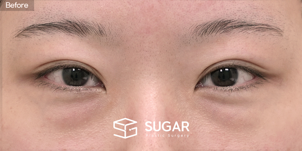 SUGAR Plastic Surgery First) Lateral canthoplasty + Lower canthoplasty + Lower fat reposition Before & After - before