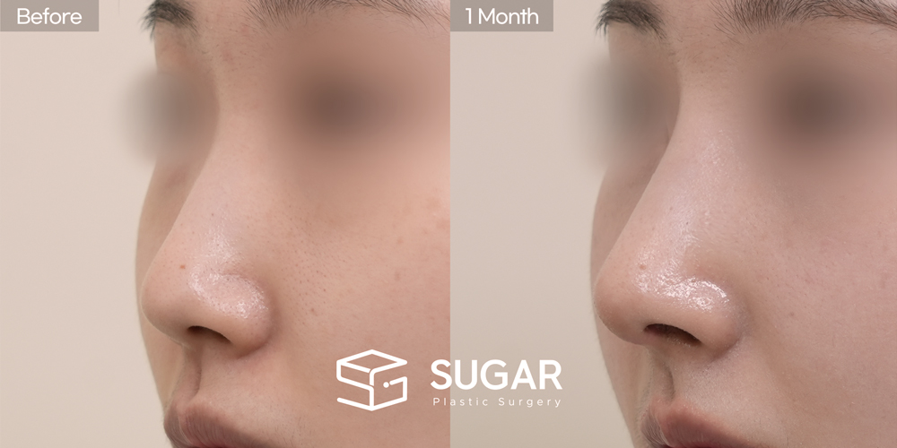 SUGAR Plastic Surgery First) Nose dorsum augmentation + Tip plasty(Artificial rib cartilage + Ear Cartilage) + Osteo + bulbous tip correction Before & After - 45-degree before-and-after comparison