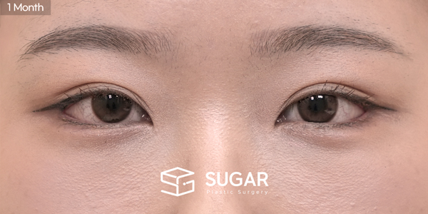 SUGAR Plastic Surgery First) Lateral canthoplasty + Lower canthoplasty + Lower fat reposition Before & After - after