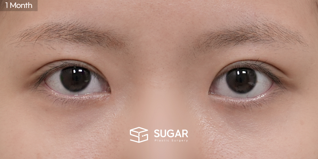 SUGAR Plastic Surgery First) Non-incisional Ptosis Correction + Medial Epicanthoplasty Before & After - after