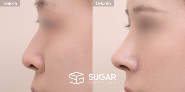 SUGAR Plastic Surgery First) Nose dorsum augmentation + Artificial rib cartilage + Septal cartilage + Hump reduction + Alar Rim Lowering + Alar reduction Before & After - side-view before-and-after comparison