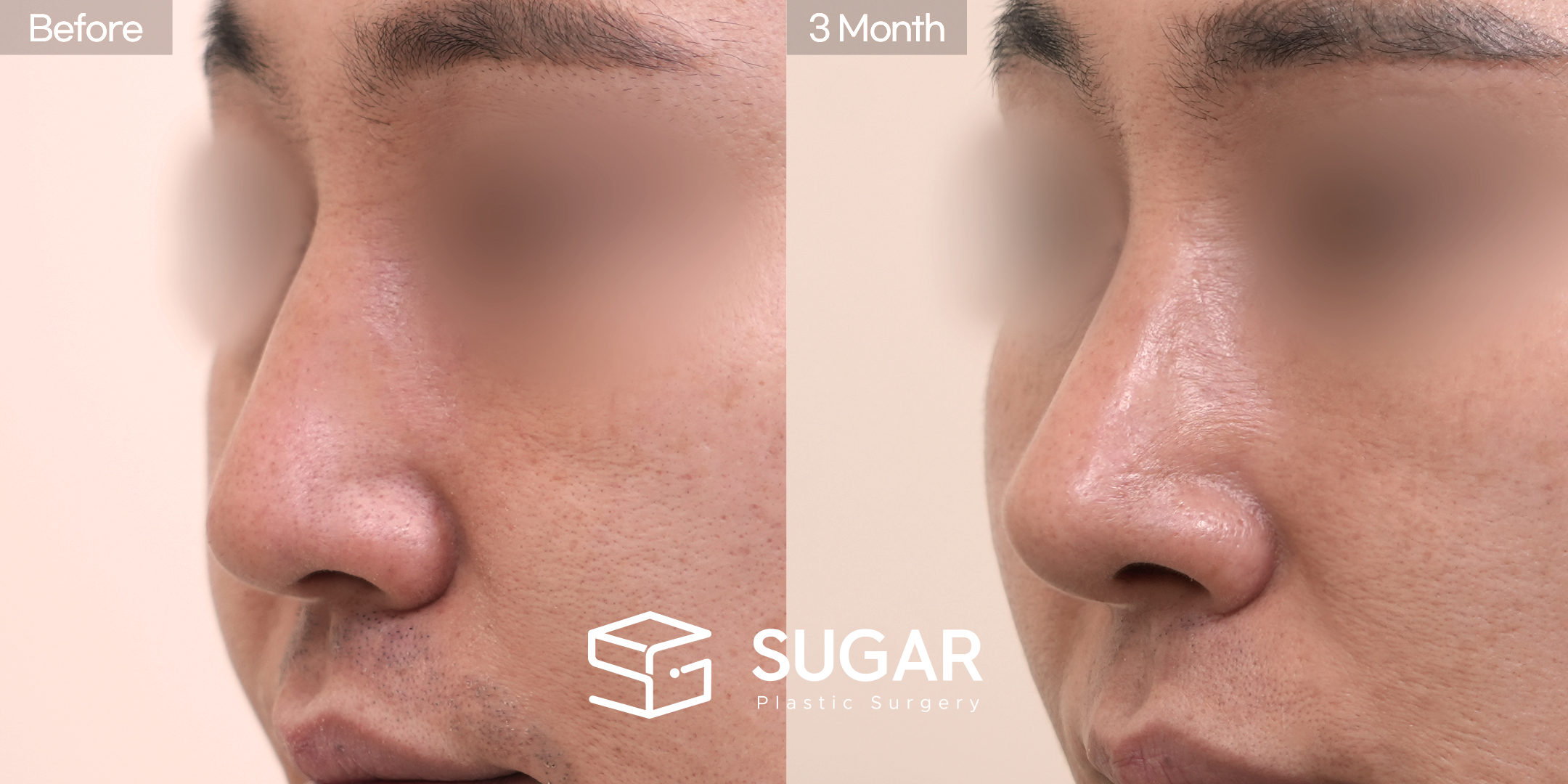SUGAR Plastic Surgery First) Non-implant + Ear Cartilage + Septal cartilage + Osteo + Deviated nose correction + bulbous tip correction Before & After - 45-degree before-and-after comparison