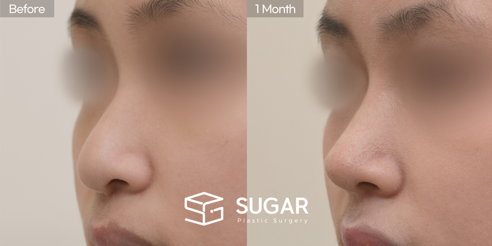 SUGAR Plastic Surgery First) Nasal Bridge Augmentation + Postauricular Fascia + Nasal Tip Plasty + Ear Cartilage Graft + Nasal Septum + Bulbous Tip Correction + Long Nose Shortening Before & After - 45-degree before-and-after comparison