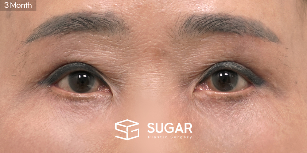 SUGAR Plastic Surgery Revision) Sub-brow Lift + Lower Blepharoplasty Before & After - after