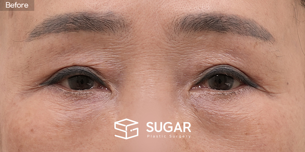 SUGAR Plastic Surgery Revision) Sub-brow Lift + Lower Blepharoplasty Before & After - before