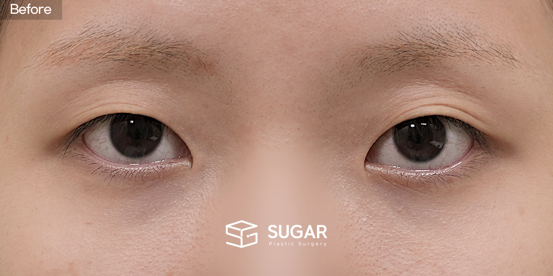 SUGAR Plastic Surgery First) Non-incisional Ptosis Correction + Medial Epicanthoplasty Before & After - before