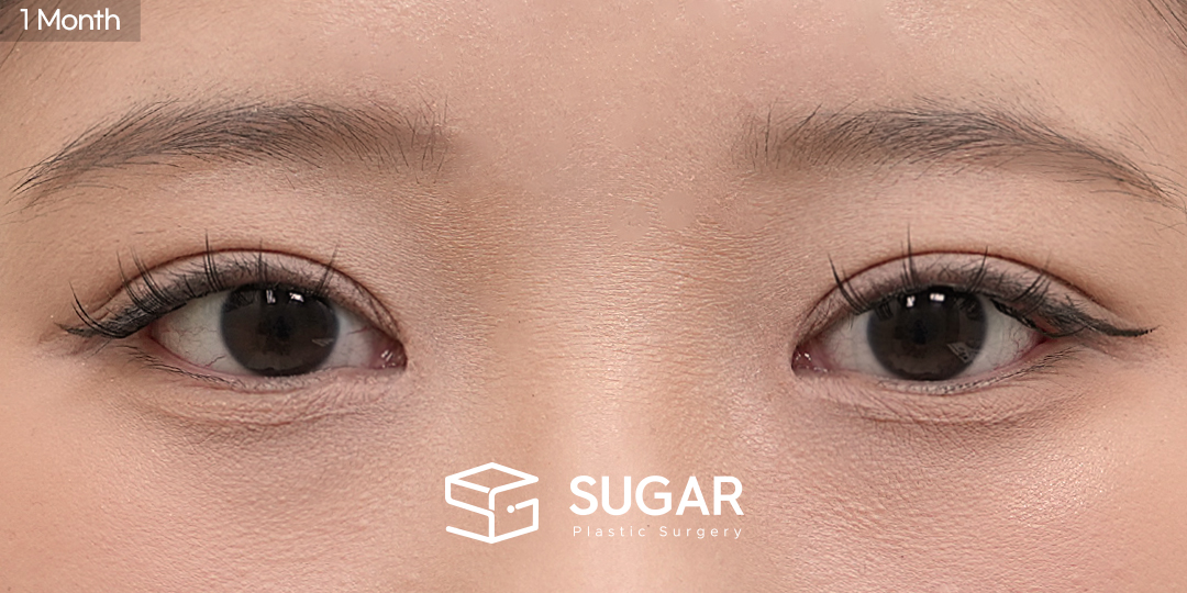 SUGAR Plastic Surgery First) Non incisional double eyelid + Ptosis correction + Epicanthoplasty Before & After - after