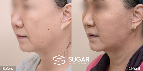 SUGAR Plastic Surgery First) Facelift + Natural-Adhesion Double Eyelid + Lower Blepharoplasty + Brow Lift Before & After - side-view before-and-after comparison