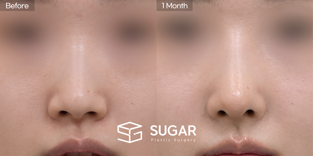 SUGAR Plastic Surgery First) Donor Rib Cartilage + Ear Cartilage Graft + Nasal Bridge Augmentation + Osteotomy + Bulbous Tip Correction Before & After - front-view before-and-after comparison