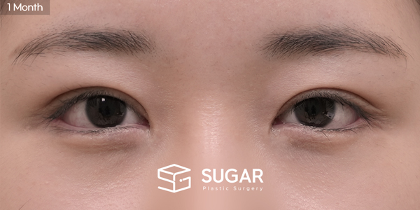 SUGAR Plastic Surgery First) Non incisional double eyelid + Upper canthoplasty + Lateral canthoplasty + Lower canthoplasty Before & After - after