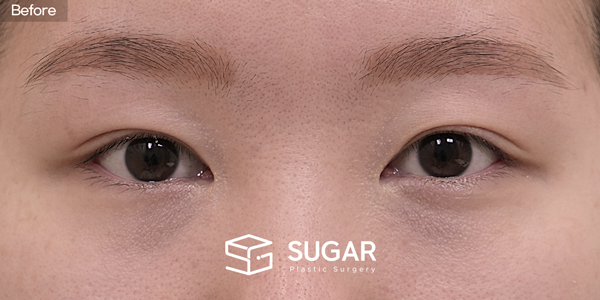 SUGAR Plastic Surgery First) Non incisional double eyelid + Upper canthoplasty Before & After - before