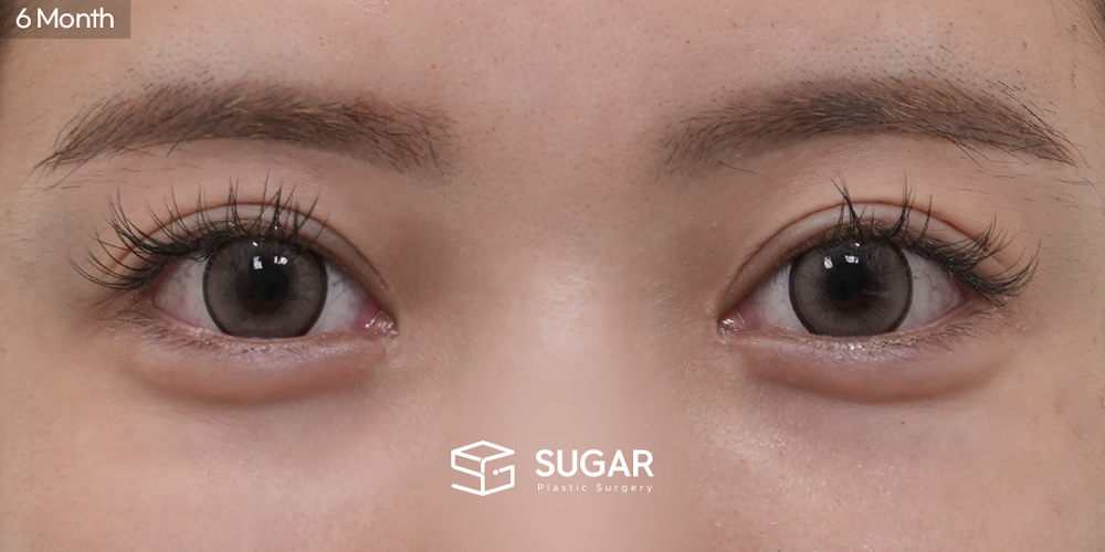 SUGAR Plastic Surgery Revision) Incisional Double Eyelid Before & After - after