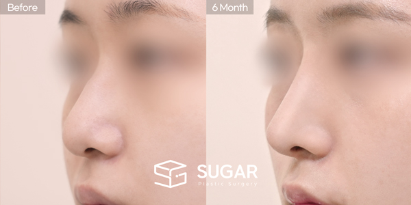 SUGAR Plastic Surgery First) Nose dorsum augmentation + Ear Cartilage + Artificial rib cartilage + Osteo + bulbous tip correction Before & After - 45-degree before-and-after comparison