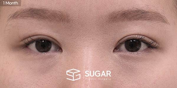 SUGAR Plastic Surgery First) Non incisional double eyelid + Upper canthoplasty Before & After - after
