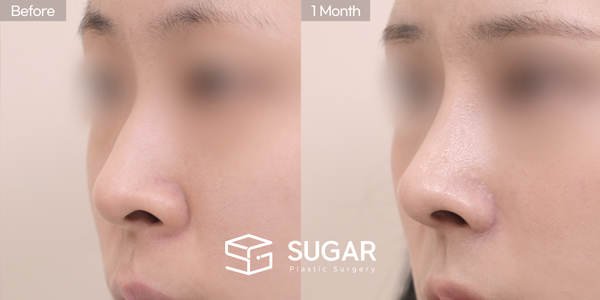 SUGAR Plastic Surgery First) Nose dorsum augmentation + Artificial rib cartilage + Septal cartilage + Hump reduction + Alar Rim Lowering + Alar reduction Before & After - 45-degree before-and-after comparison
