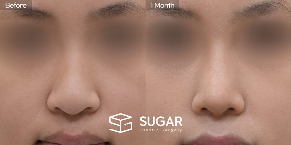 SUGAR Plastic Surgery First) Nasal Bridge Augmentation + Postauricular Fascia + Nasal Tip Plasty + Nasal Septum + Ear Cartilage Graft + Bulbous Tip Correction + Long Nose Shortening Before & After - front-view before-and-after comparison