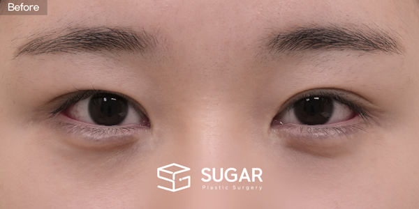 SUGAR Plastic Surgery First) Non incisional double eyelid + Upper canthoplasty + Lateral canthoplasty + Lower canthoplasty Before & After - before