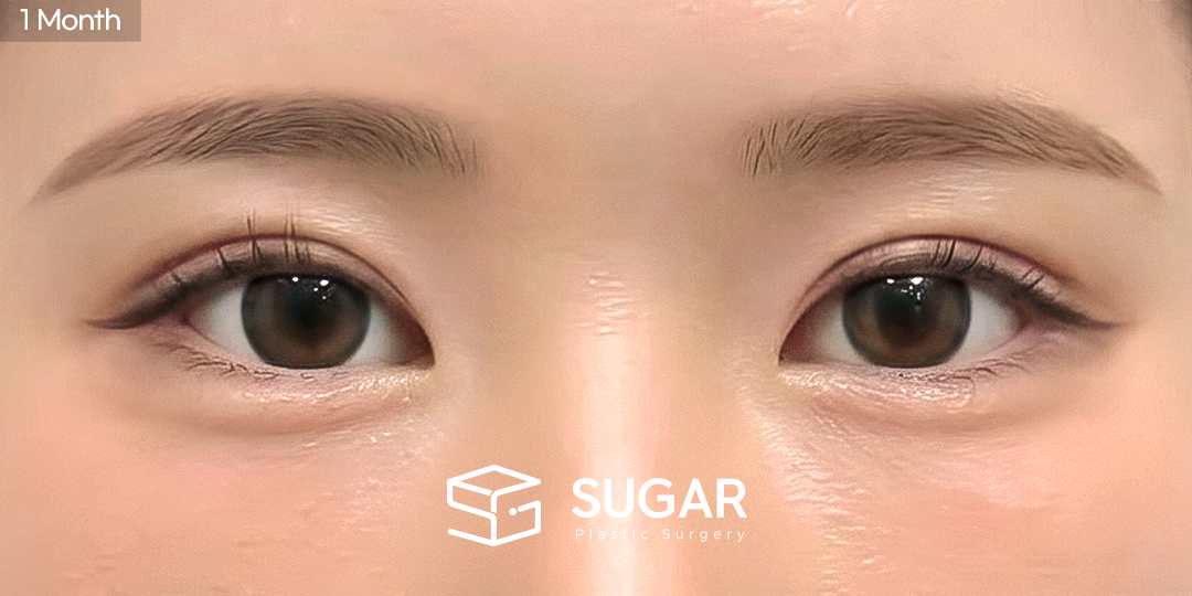 SUGAR Plastic Surgery First) Non incisional double eyelid + Ptosis correction + Epicanthoplasty Before & After - after