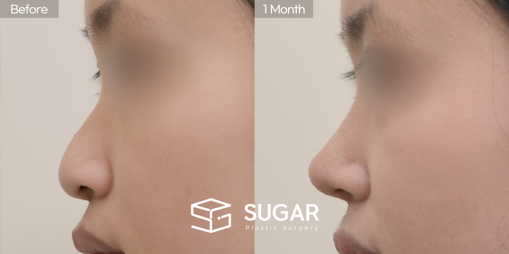 SUGAR Plastic Surgery First) Nasal Bridge Augmentation + Postauricular Fascia + Nasal Tip Plasty + Ear Cartilage Graft + Nasal Septum + Bulbous Tip Correction + Long Nose Shortening Before & After - side-view before-and-after comparison