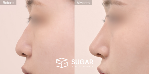 SUGAR Plastic Surgery First) Nose dorsum augmentation + Ear Cartilage + Artificial rib cartilage + Osteo + bulbous tip correction Before & After - side-view before-and-after comparison