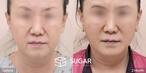 SUGAR Plastic Surgery First) Facelift + Natural-Adhesion Double Eyelid + Lower Blepharoplasty + Brow Lift Before & After - front-view before-and-after comparison