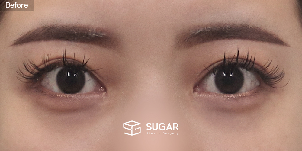 SUGAR Plastic Surgery Revision) Incisional Double Eyelid Before & After - before