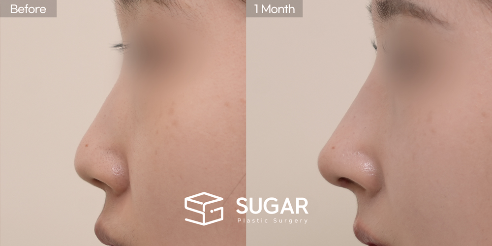 SUGAR Plastic Surgery First) Nose dorsum augmentation + Tip plasty(Artificial rib cartilage + Ear Cartilage) + Osteo + bulbous tip correction Before & After - side-view before-and-after comparison