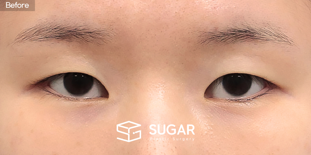 SUGAR Plastic Surgery First) Non incisional double eyelid + Ptosis correction + Epicanthoplasty Before & After - before