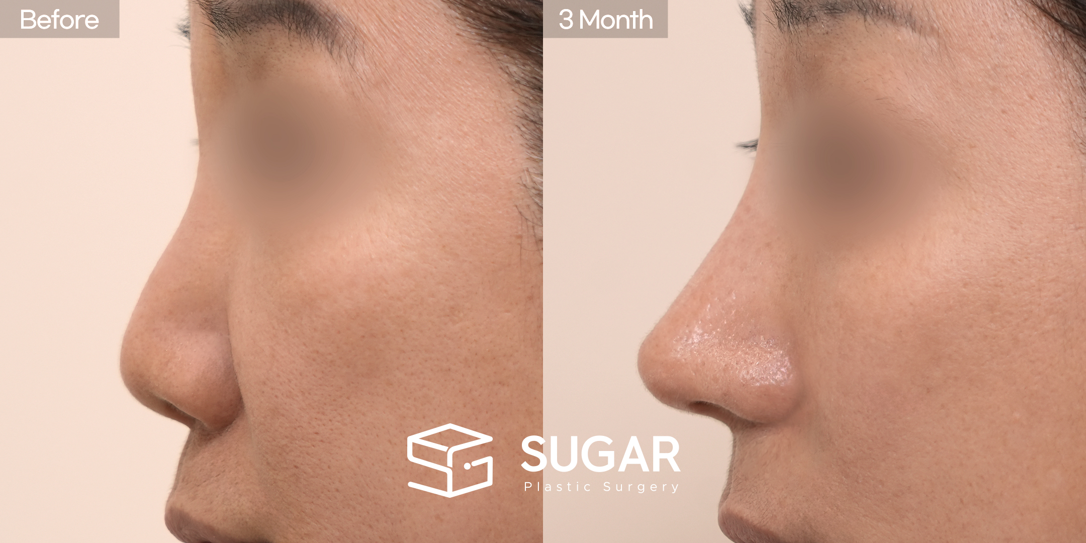 SUGAR Plastic Surgery First) Nose Bridge & Tip + bulbous tip correction + Alar reduction + Osteo Before & After - side-view before-and-after comparison