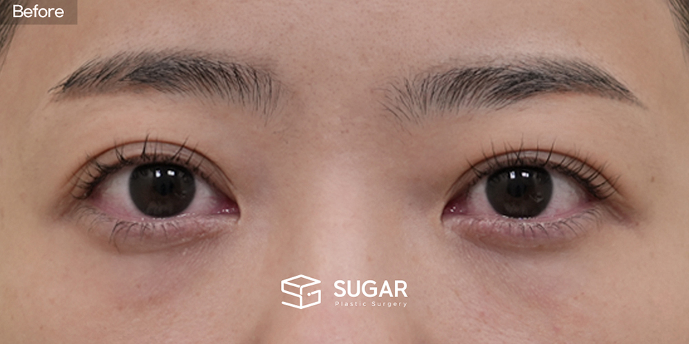 SUGAR Plastic Surgery First) Lower Eyelid Fat Repositioning + Forehead Lift + Implant-Free Rhinoplasty + Autologous Rib Cartilage + Alar Reduction + Bulbous Tip Correction + Columellar Lengthening Before & After - before
