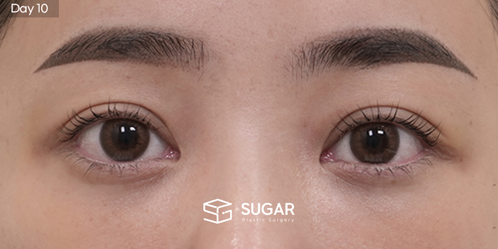 SUGAR Plastic Surgery First) Lower Eyelid Fat Repositioning + Forehead Lift + Implant-Free Rhinoplasty + Autologous Rib Cartilage + Alar Reduction + Bulbous Tip Correction + Columellar Lengthening Before & After - after