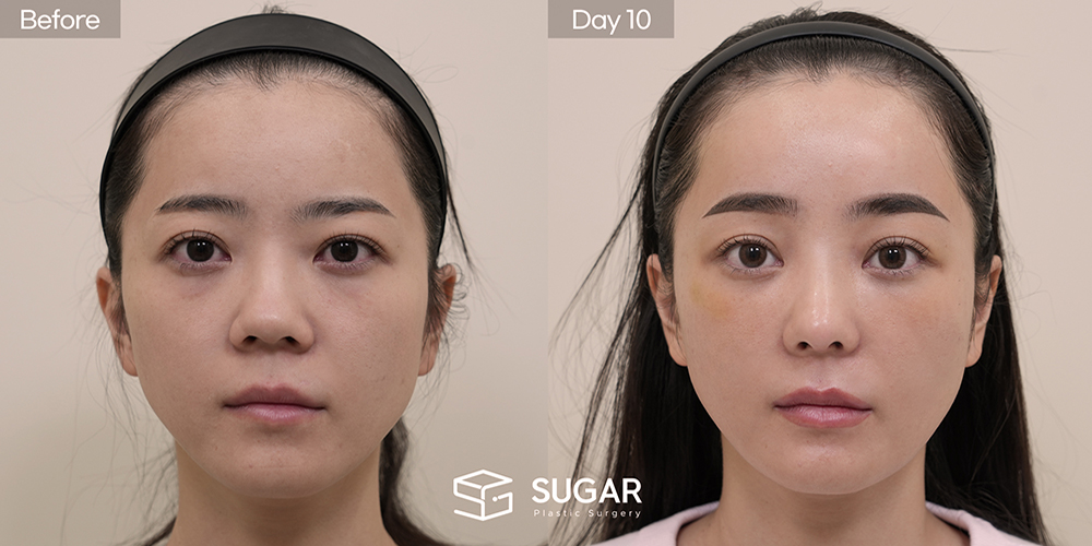 SUGAR Plastic Surgery First) Lower Eyelid Fat Repositioning + Forehead Lift + Implant-Free Rhinoplasty + Autologous Rib Cartilage + Alar Reduction + Bulbous Tip Correction + Columellar Lengthening Before & After - front-view before-and-after comparison