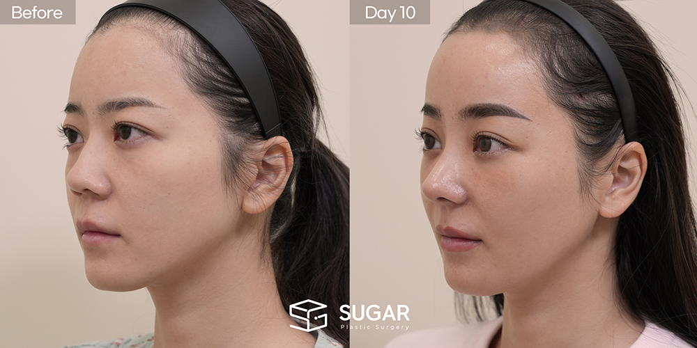 SUGAR Plastic Surgery First) Lower Eyelid Fat Repositioning + Forehead Lift + Implant-Free Rhinoplasty + Autologous Rib Cartilage + Alar Reduction + Bulbous Tip Correction + Columellar Lengthening Before & After - 45-degree before-and-after comparison