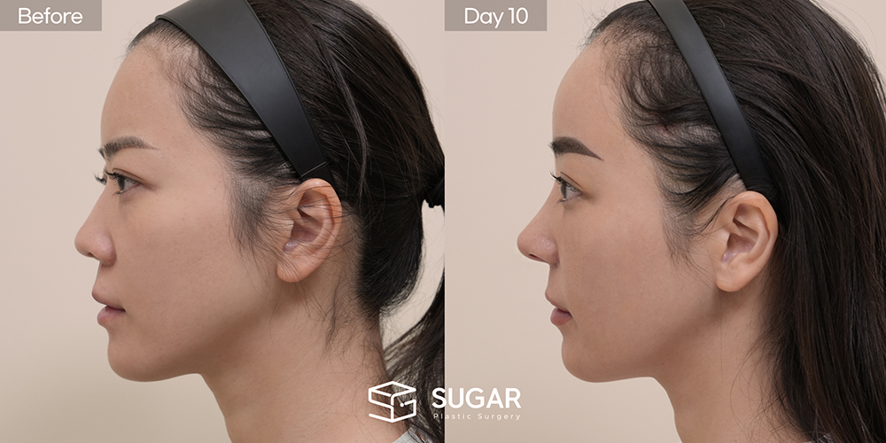 SUGAR Plastic Surgery First) Lower Eyelid Fat Repositioning + Forehead Lift + Implant-Free Rhinoplasty + Autologous Rib Cartilage + Alar Reduction + Bulbous Tip Correction + Columellar Lengthening Before & After - side-view before-and-after comparison