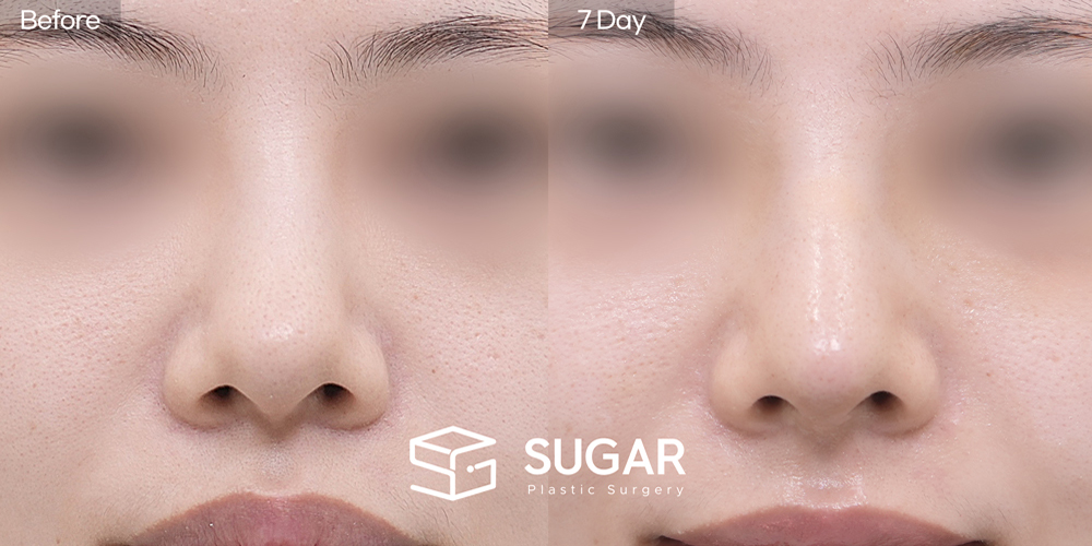 SUGAR Plastic Surgery First) Nasal Bridge Augmentation + Nasal Tip Plasty + Nasal Septum + Ear Cartilage Graft + Donor Rib Cartilage + Columellar Lengthening + Bulbous Tip Correction Before & After - front-view before-and-after comparison