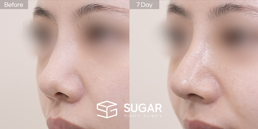 SUGAR Plastic Surgery First) Nasal Bridge Augmentation + Nasal Tip Plasty + Nasal Septum + Ear Cartilage Graft + Donor Rib Cartilage + Columellar Lengthening + Bulbous Tip Correction Before & After - 45-degree before-and-after comparison