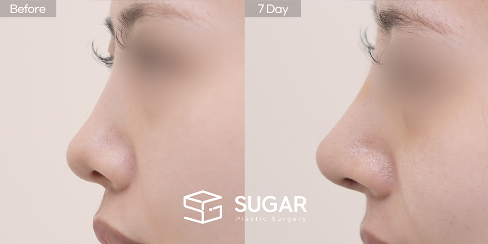 SUGAR Plastic Surgery First) Nasal Bridge Augmentation + Nasal Tip Plasty + Nasal Septum + Ear Cartilage Graft + Donor Rib Cartilage + Columellar Lengthening + Bulbous Tip Correction Before & After - side-view before-and-after comparison