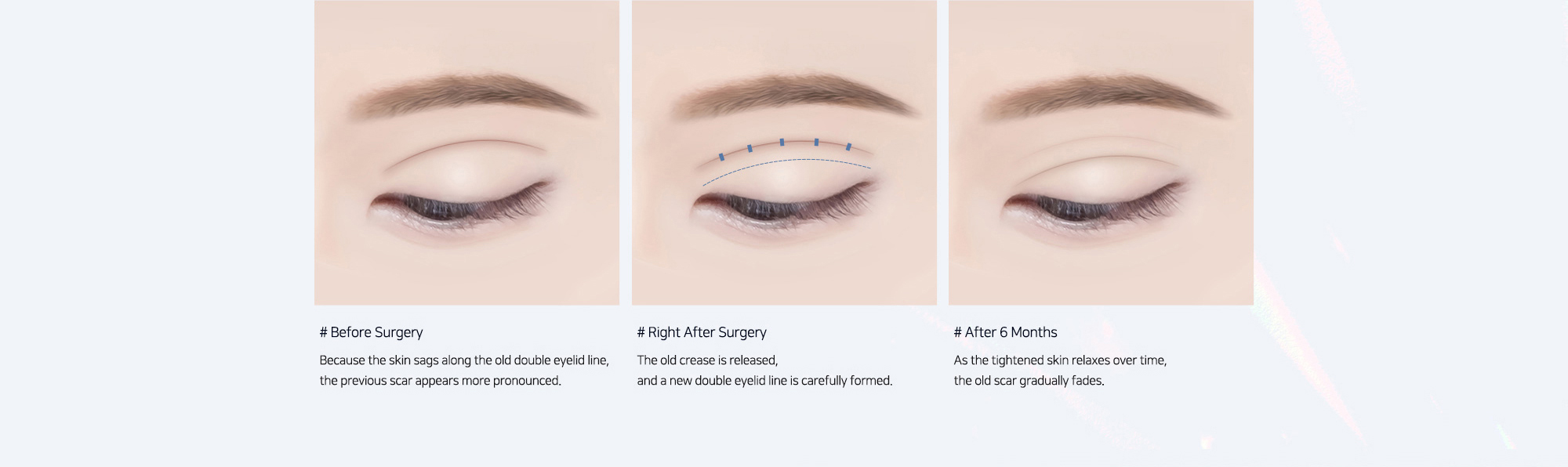 # Before Surgery : Because the skin sags along the old double eyelid line, the previous scar appears more pronounced.   # Right After Surgery : The old crease is released, and a new double eyelid line is carefully formed.   # After 6 Months : As the tightened skin relaxes over time, the old scar gradually fades.