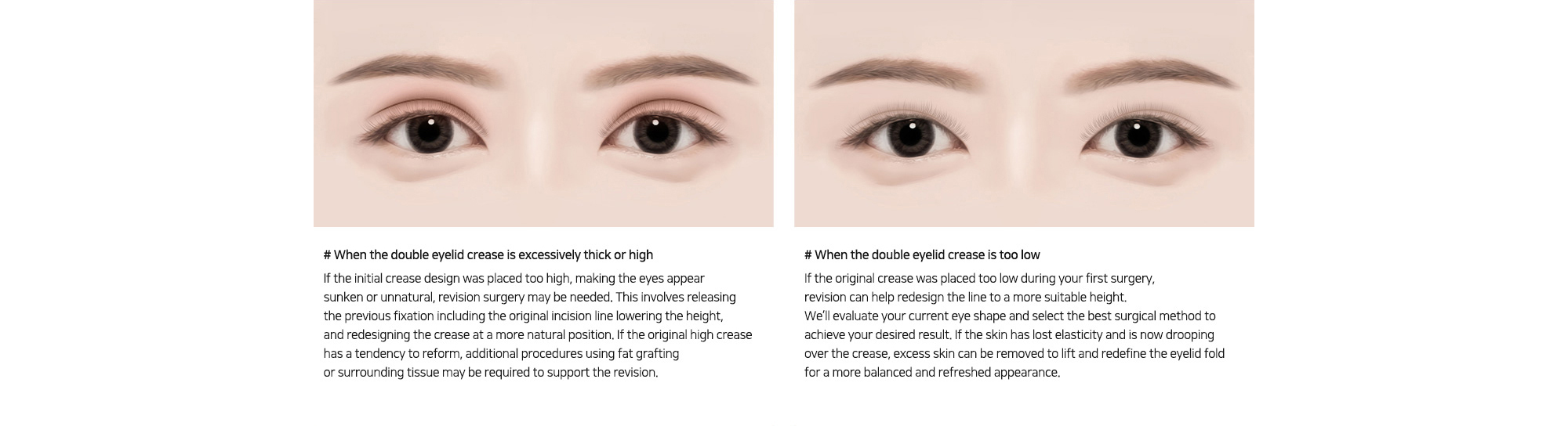# When the double eyelid crease is excessively thick or high : If the initial crease design was placed too high, making the eyes appear sunken or unnatural, revision surgery may be needed. This involves releasing the previous fixation including the original incision line lowering the height, and redesigning the crease at a more natural position.   /   # When the double eyelid crease is too low : If the original crease was placed too low during your first surgery, revision can help redesign the line to a more suitable height. We’ll evaluate your current eye shape and select the best surgical method to achieve your desired result. 