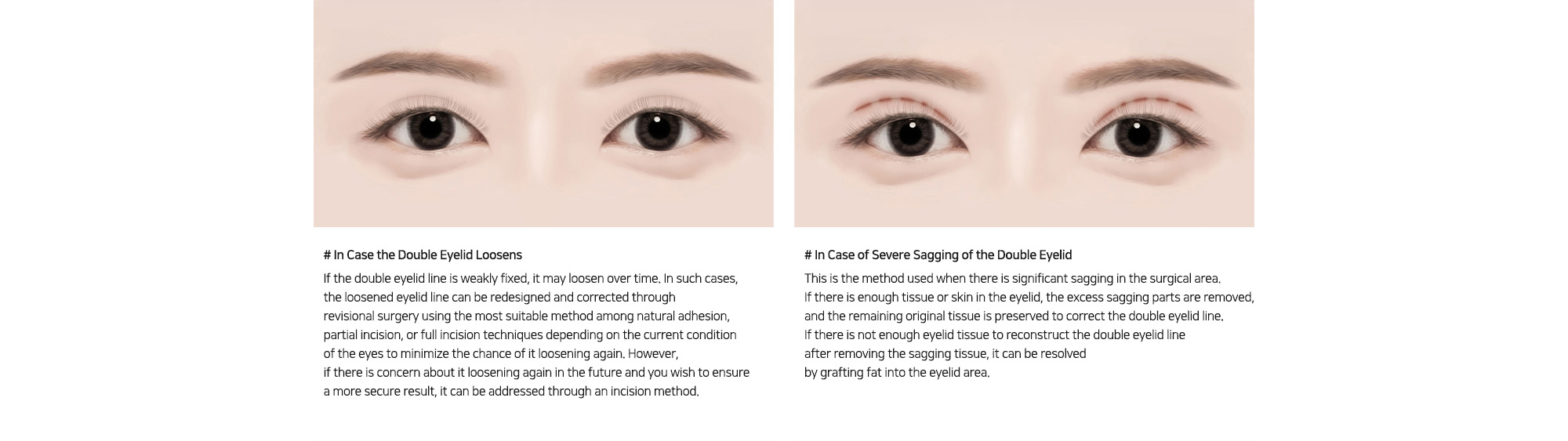 # In Case the Double Eyelid Loosens : If the double eyelid line is weakly fixed, it may loosen over time. In such cases, the loosened eyelid line can be redesigned and corrected through revisional surgery using the most suitable method among natural adhesion, partial incision, or full incision techniques depending on the current condition of the eyes to minimize the chance of it loosening again.   # In Case of Severe Sagging of the Double Eyelid : This is the method used when there is significant sagging in the surgical area. If there is enough tissue or skin in the eyelid, the excess sagging parts are removed, and the remaining original tissue is preserved to correct the double eyelid line.