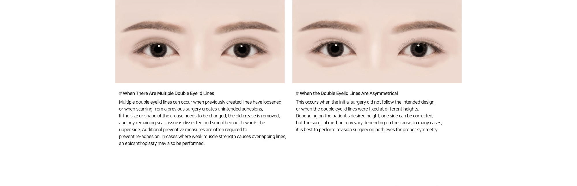 # When There Are Multiple Double Eyelid Lines : If the size or shape of the crease needs to be changed, the old crease is removed, and any remaining scar tissue is dissected and smoothed out towards the upper side. Additional preventive measures are often required to prevent re-adhesion.   # When the Double Eyelid Lines Are Asymmetrical : Depending on the patient's desired height, one side can be corrected, but the surgical method may vary depending on the cause. In many cases, it is best to perform revision surgery on both eyes for proper symmetry.