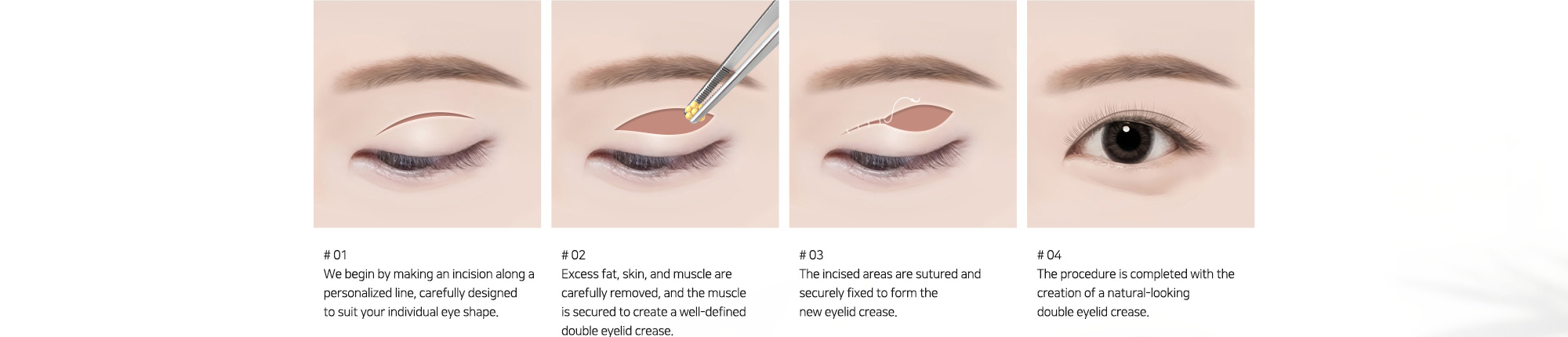# 01 : We begin by making an incision along a personalized line, carefully designed to suit your individual eye shape.   # 02 : Excess fat, skin, and muscle are carefully removed, and the muscle is secured to create a well-defined double eyelid crease.   # 03 : The incised areas are sutured and securely fixed to form the new eyelid crease.   # 04 : The procedure is completed with the creation of a natural-looking double eyelid crease.