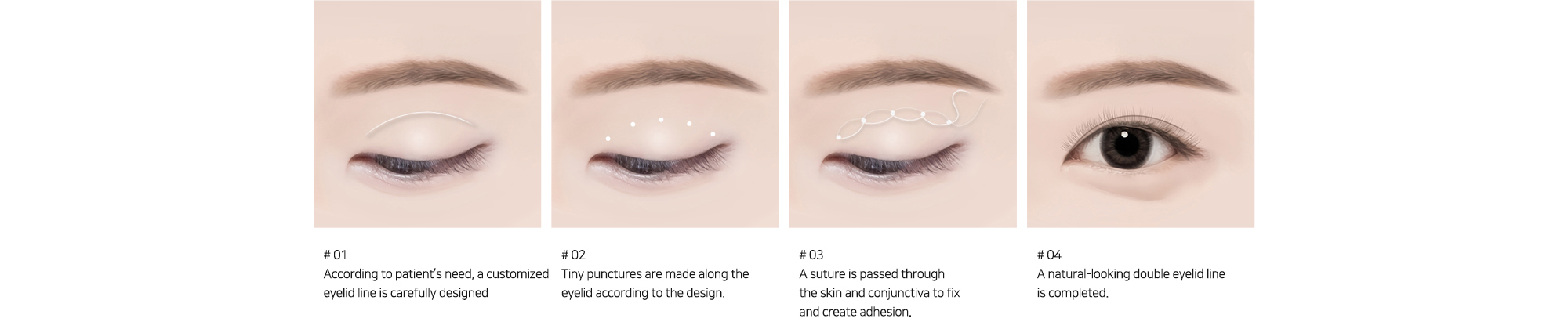 # 01 : According to patient?셲 need, a customized eyelid line is carefully designed  # 02 : Tiny punctures are made along the eyelid according to the design. # 03 : A suture is passed through the skin and conjunctiva to fix and create adhesion. # 04 : A natural-looking double eyelid line is completed.