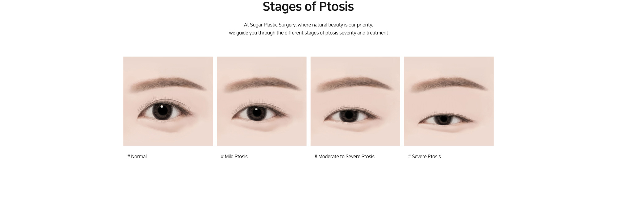 [Stages of Ptosis] At Sugar Plastic Surgery, where natural beauty is our priority, we guide you through the different stages of ptosis severity and treatment
