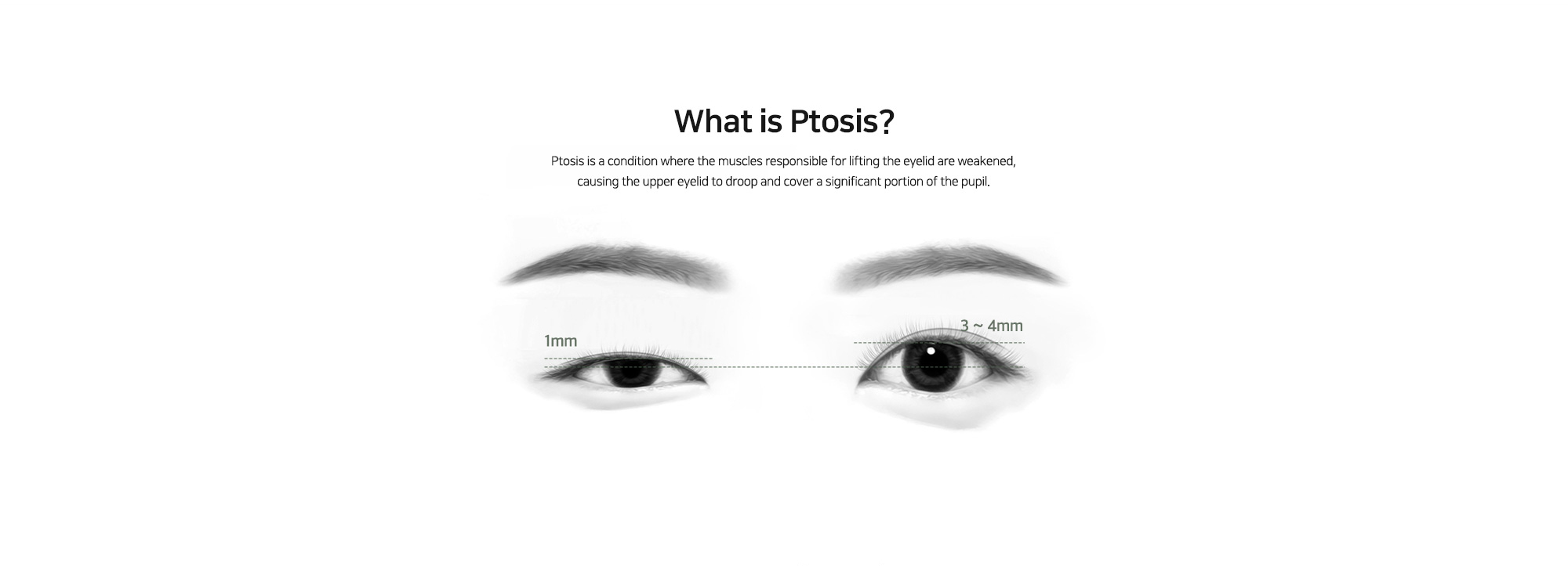 [What is Ptosis?] Ptosis is a condition where the muscles responsible for lifting the eyelid are weakened, causing the upper eyelid to droop and cover a significant portion of the pupil.