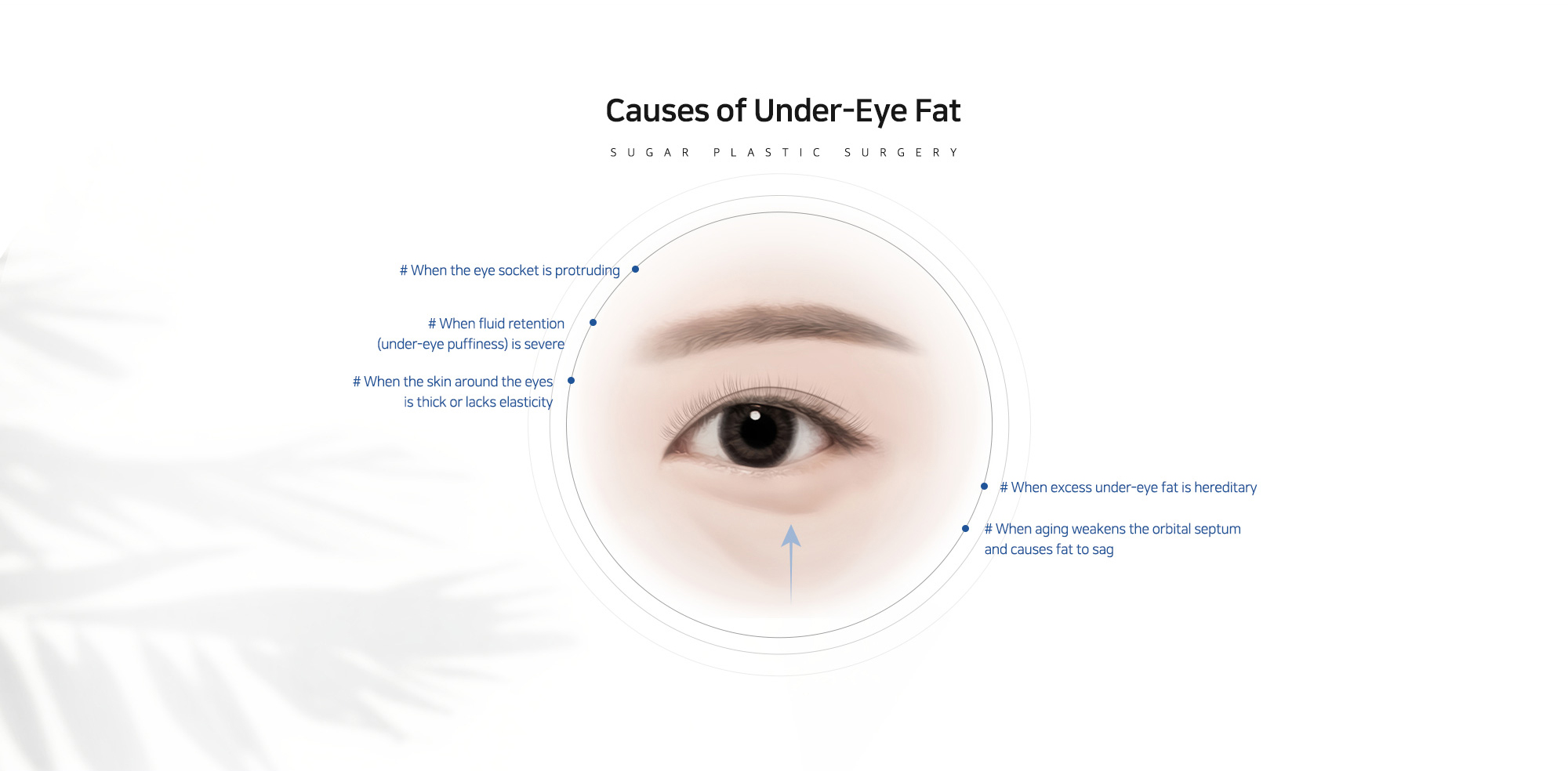 [Causes of Under-Eye Fat] # When the eye socket is protruding  # When fluid retention (under-eye puffiness) is severe   # When the skin around the eyes is thick or lacks elasticity   # When excess under-eye fat is hereditary   # When aging weakens the orbital septum and causes fat to sag