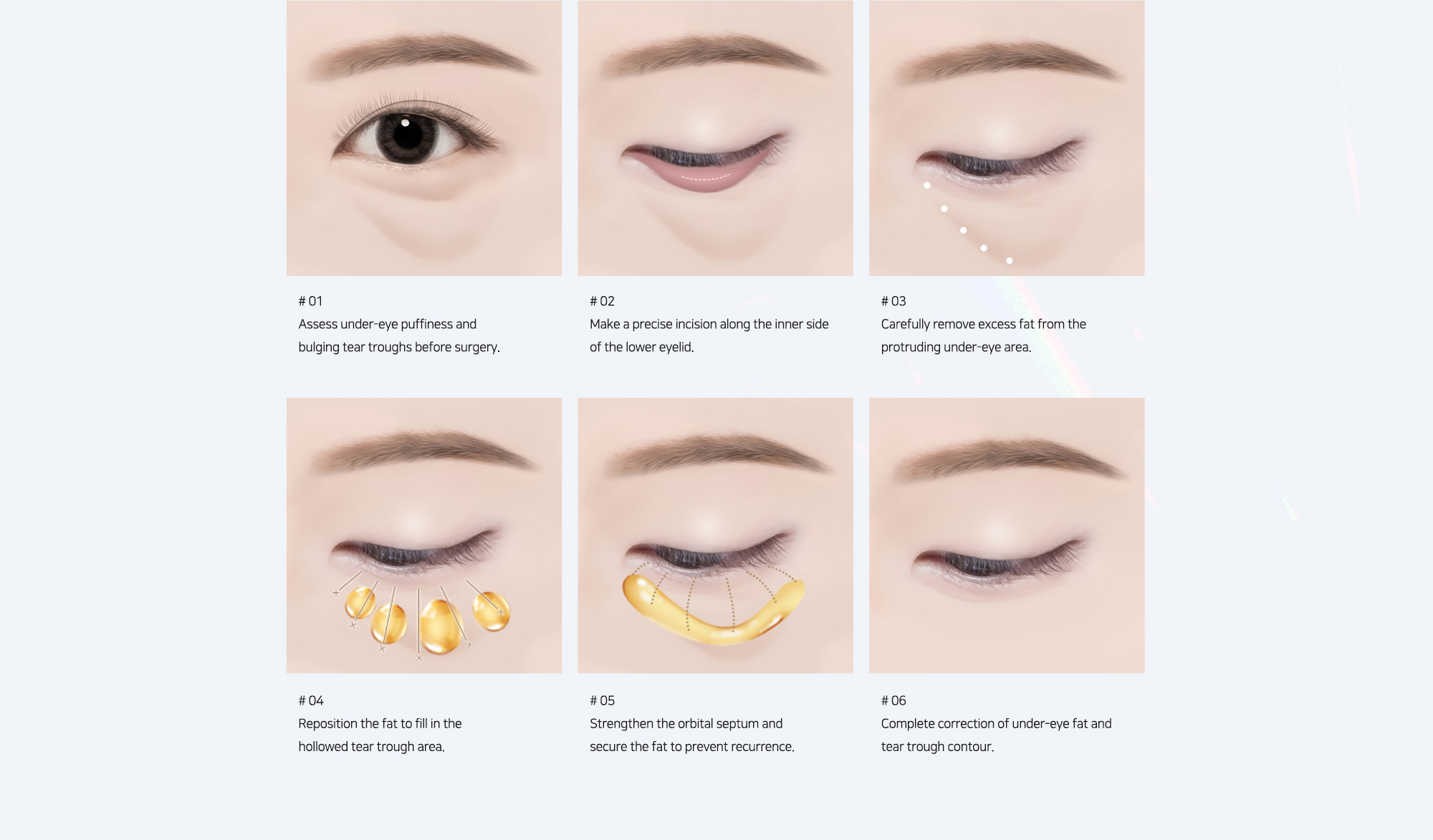 # 01 : Assess under-eye puffiness and bulging tear troughs before surgery.   # 02 : Make a precise incision along the inner side of the lower eyelid.   # 03 : Carefully remove excess fat from the protruding under-eye area.   # 04 : Reposition the fat to fill in the hollowed tear trough area.   # 05 : Strengthen the orbital septum and secure the fat to prevent recurrence.   # 06 : Complete correction of under-eye fat and tear trough contour.