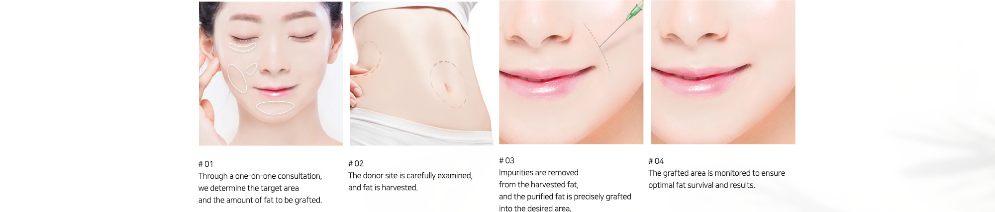 # 01 : Through a one-on-one consultation, we determine the target area and the amount of fat to be grafted.   # 02 : The donor site is carefully examined, and fat is harvested.   # 03 : Impurities are removed from the harvested fat, and the purified fat is precisely grafted into the desired area.   # 04 : The grafted area is monitored to ensure optimal fat survival and results.