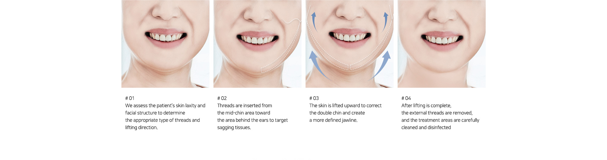 # 01 : We assess the patient’s skin laxity and facial structure to determine the appropriate type of threads and lifting direction.   # 02 : Threads are inserted from the mid-chin area toward the area behind the ears to target sagging tissues.   # 03 : The skin is lifted upward to correct the double chin and create a more defined jawline.   # 04 : After lifting is complete, the external threads are removed, and the treatment areas are carefully cleaned and disinfected