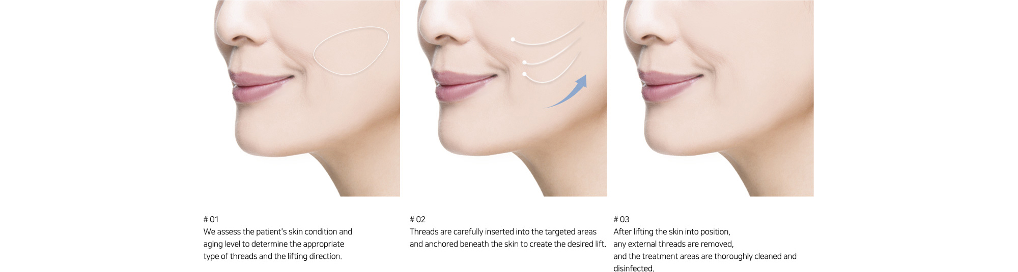 # 01 : We assess the patient's skin condition and aging level to determine the appropriate type of threads and the lifting direction.   # 02 : Threads are carefully inserted into the targeted areas and anchored beneath the skin to create the desired lift.   # 03 : After lifting the skin into position, any external threads are removed, and the treatment areas are thoroughly cleaned and disinfected.